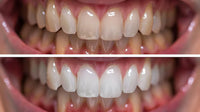 Nivio Labs - Teeth Whitening Strips Professional At-Home Whitening Kit